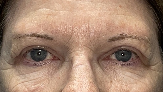 Combination Surgeries (eyelid lift and other)