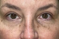 Upper Lid Blepharoplasty (upper eyelid lift)