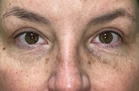 Upper Lid Blepharoplasty (upper eyelid lift)