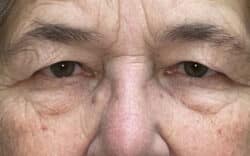 Eyelid Lift (Blepharoplasty/Ptosis Repair)