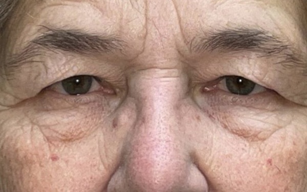 Eyelid Lift (Blepharoplasty/Ptosis Repair)