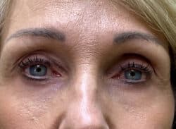 Combination Surgeries (eyelid lift and other)