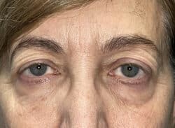 Combination Surgeries (eyelid lift and other)