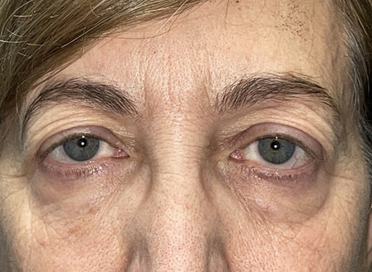 Combination Surgeries (eyelid lift and other)