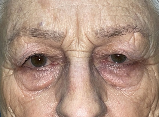 Combination Surgeries (eyelid lift and other)