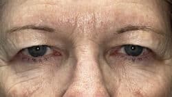 Combination Surgeries (eyelid lift and other)