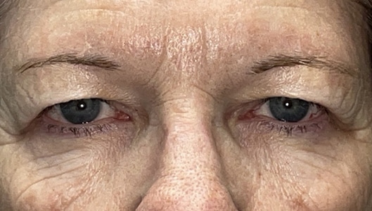 Combination Surgeries (eyelid lift and other)