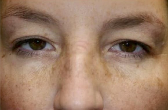Upper Lid Blepharoplasty (upper eyelid lift)
