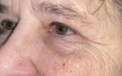 Eyelid Lift (Blepharoplasty/Ptosis Repair)