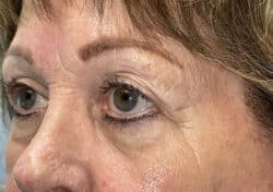 Brow/Forehead Lift