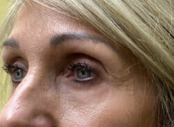 Combination Surgeries (eyelid lift and other)