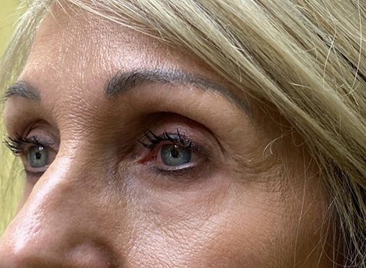 Combination Surgeries (eyelid lift and other)