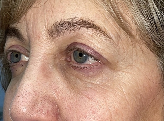 Combination Surgeries (eyelid lift and other)