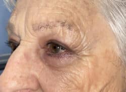 Combination Surgeries (eyelid lift and other)