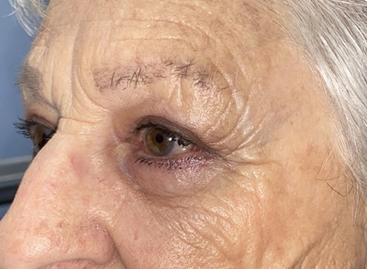 Combination Surgeries (eyelid lift and other)