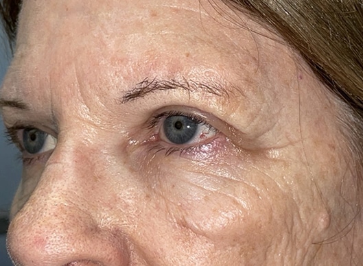 Combination Surgeries (eyelid lift and other)