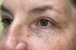 Upper Lid Blepharoplasty (upper eyelid lift)