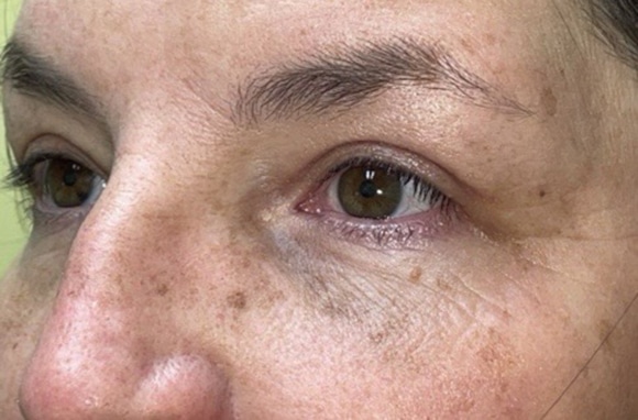 Upper Lid Blepharoplasty (upper eyelid lift)