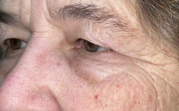 Eyelid Lift (Blepharoplasty/Ptosis Repair)