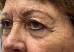 Brow/Forehead Lift