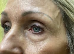 Combination Surgeries (eyelid lift and other)