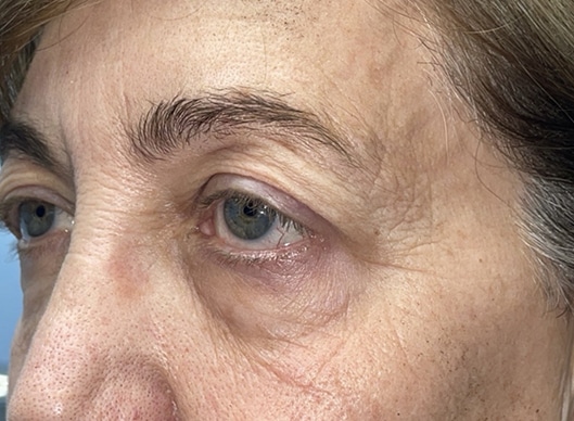 Combination Surgeries (eyelid lift and other)