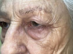 Combination Surgeries (eyelid lift and other)