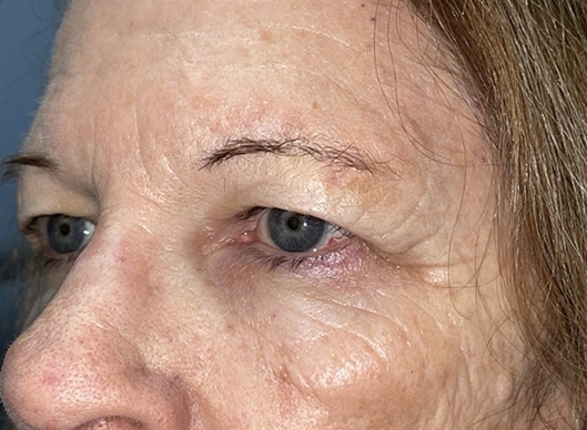 Combination Surgeries (eyelid lift and other)