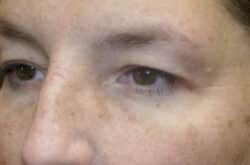 Upper Lid Blepharoplasty (upper eyelid lift)