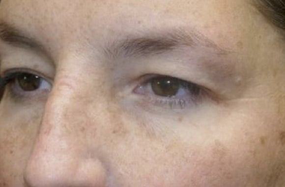 Upper Lid Blepharoplasty (upper eyelid lift)