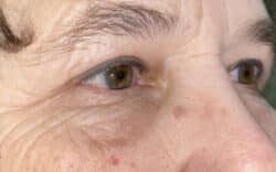 Eyelid Lift (Blepharoplasty/Ptosis Repair)