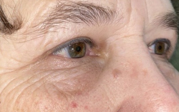 Eyelid Lift (Blepharoplasty/Ptosis Repair)