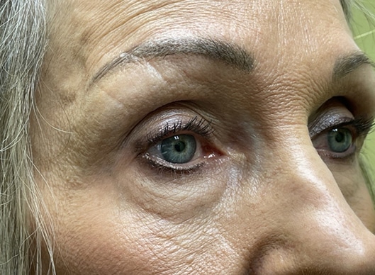 Combination Surgeries (eyelid lift and other)
