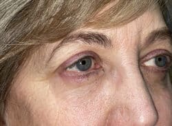 Combination Surgeries (eyelid lift and other)