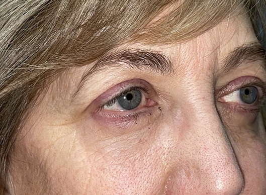 Combination Surgeries (eyelid lift and other)