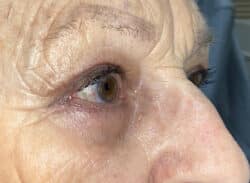 Combination Surgeries (eyelid lift and other)