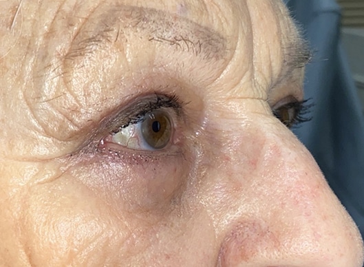 Combination Surgeries (eyelid lift and other)