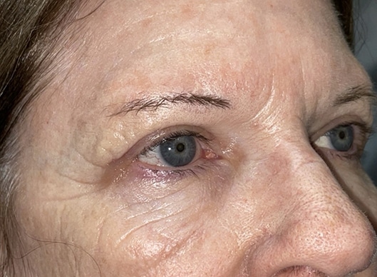 Combination Surgeries (eyelid lift and other)