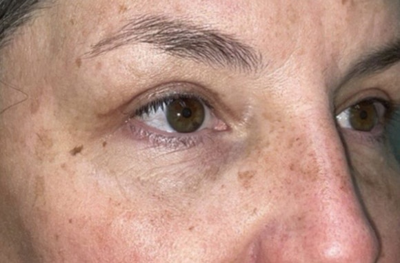 Upper Lid Blepharoplasty (upper eyelid lift)
