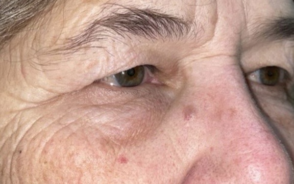 Eyelid Lift (Blepharoplasty/Ptosis Repair)