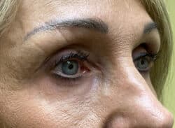 Combination Surgeries (eyelid lift and other)