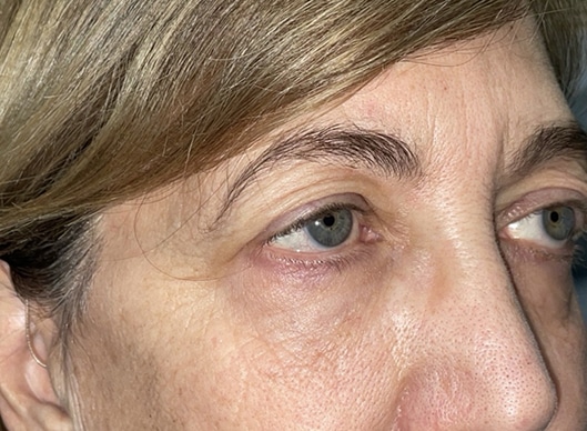 Combination Surgeries (eyelid lift and other)