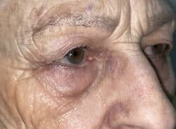 Combination Surgeries (eyelid lift and other)