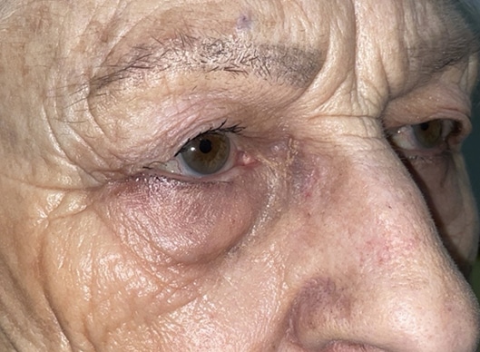 Combination Surgeries (eyelid lift and other)