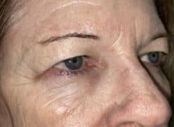 Combination Surgeries (eyelid lift and other)