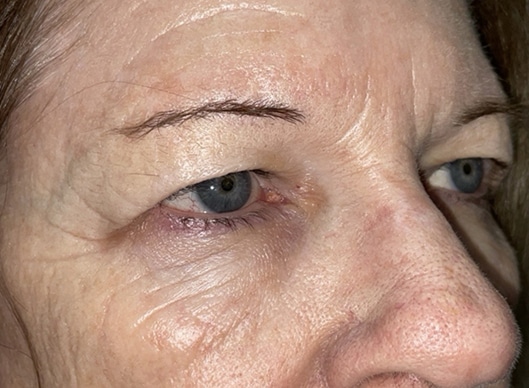 Combination Surgeries (eyelid lift and other)
