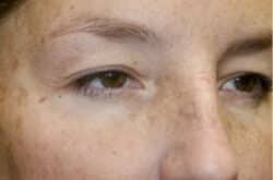Upper Lid Blepharoplasty (upper eyelid lift)