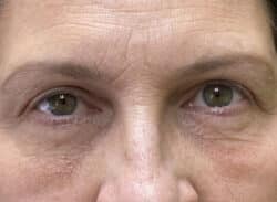 Combination Surgeries (eyelid lift and other)