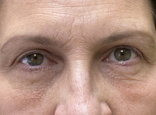 Combination Surgeries (eyelid lift and other)