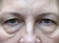 Combination Surgeries (eyelid lift and other)